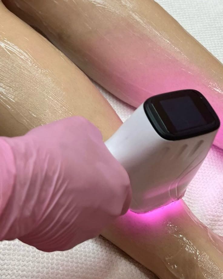 Lasersko odstranjevanje dlak v salonu Studio Unique